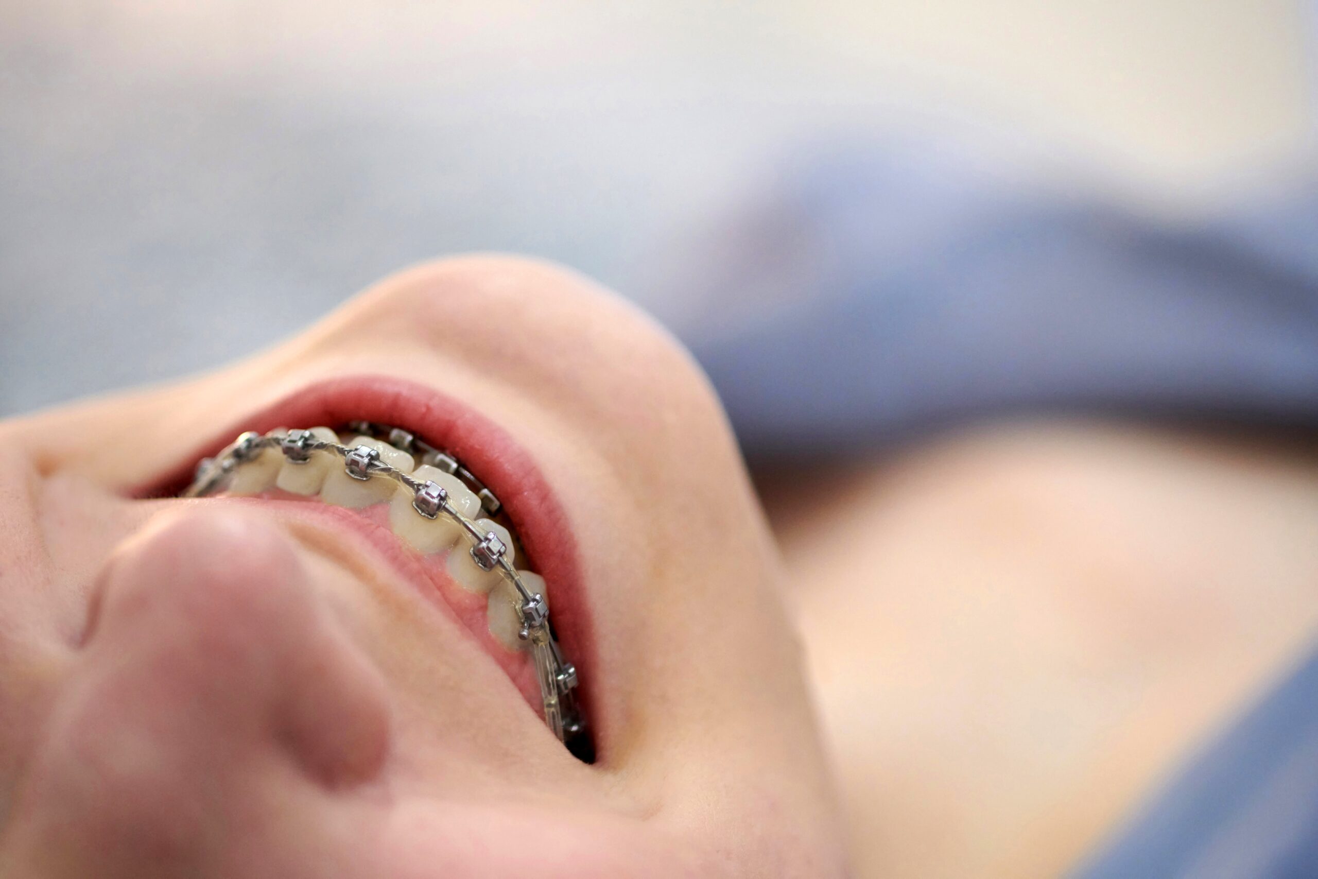 Smiling young woman with brackets on teeth close up. Metal self-ligating dental braces.