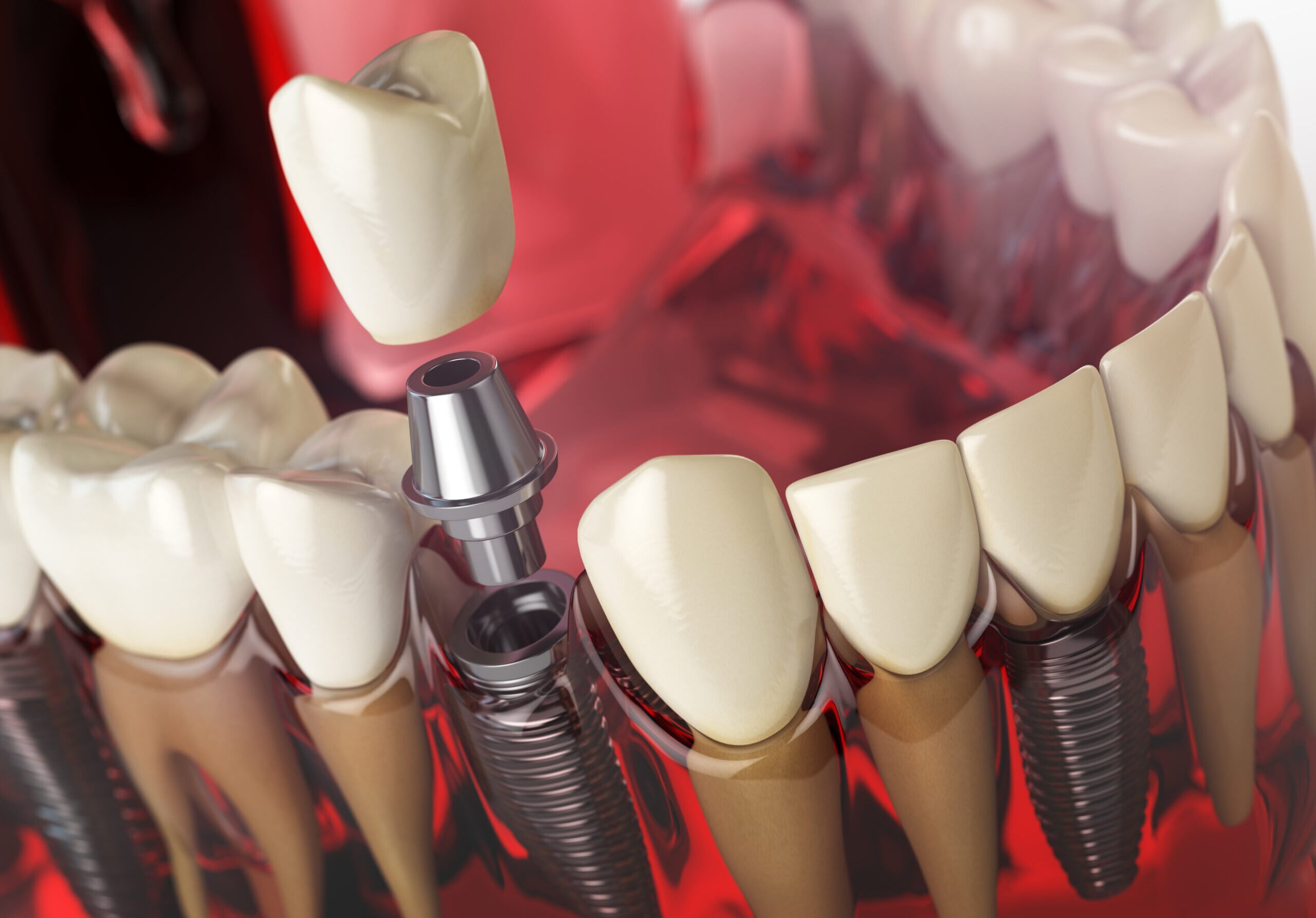 Tooth implant in the model human teeth, gums and denturas. Dental medicine stomatology concept. 3d illustration