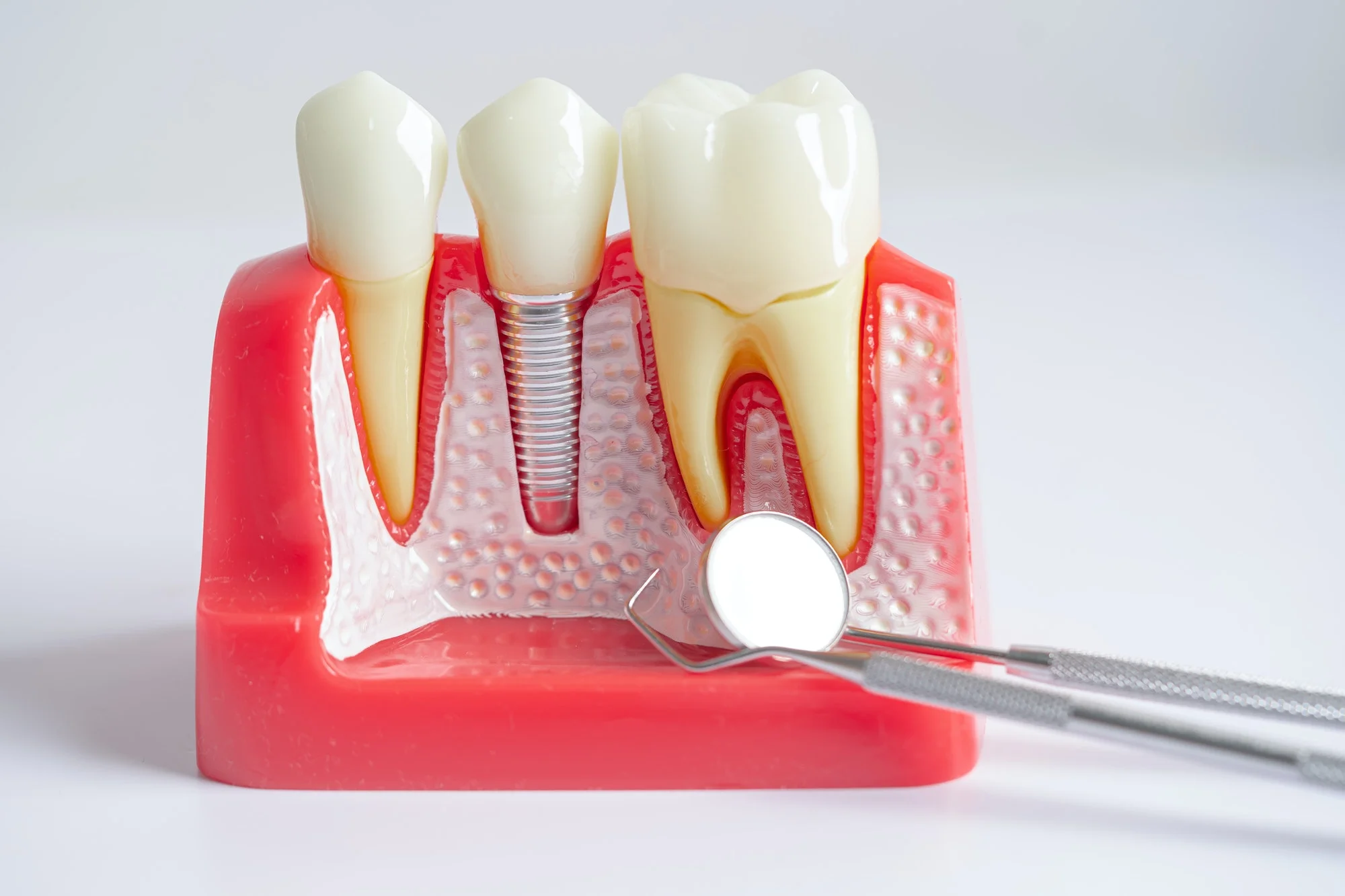 Root Canal Treatment in Senawang, Seremban 1 Dental implant, artificial tooth roots into jaw, root canal of dental treatment, gum disease
