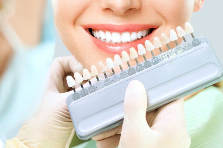 Veneers in Senawang Seremban