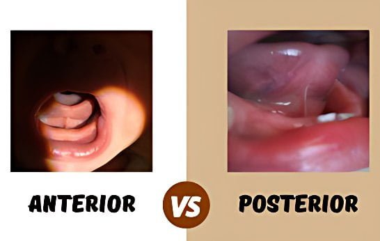 Benefits of Tongue Tie Surgery for Newborns in Seremban