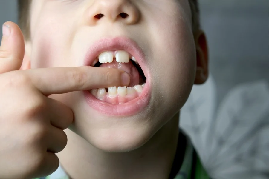 Tongue Tie Classification 7 oral cavity small patient length frenum tongue boy kid performs