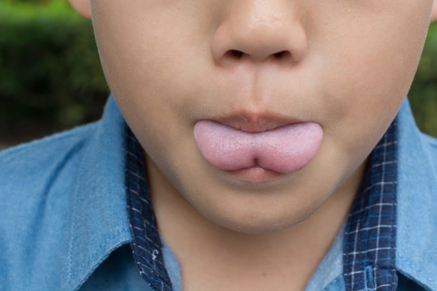 tongue tie pre operation