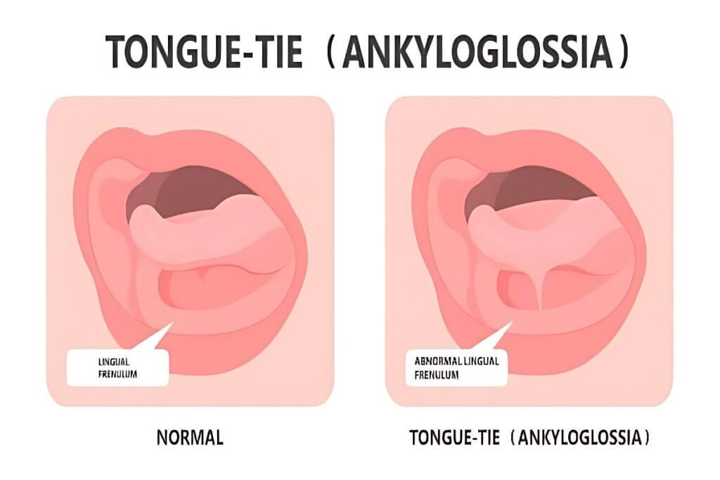 Benefits of Tongue Tie Surgery for Newborns in Seremban