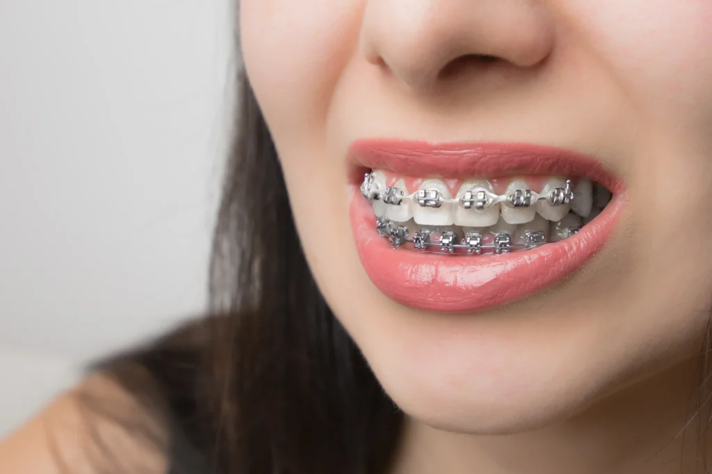 dental braces price malaysia cozy t