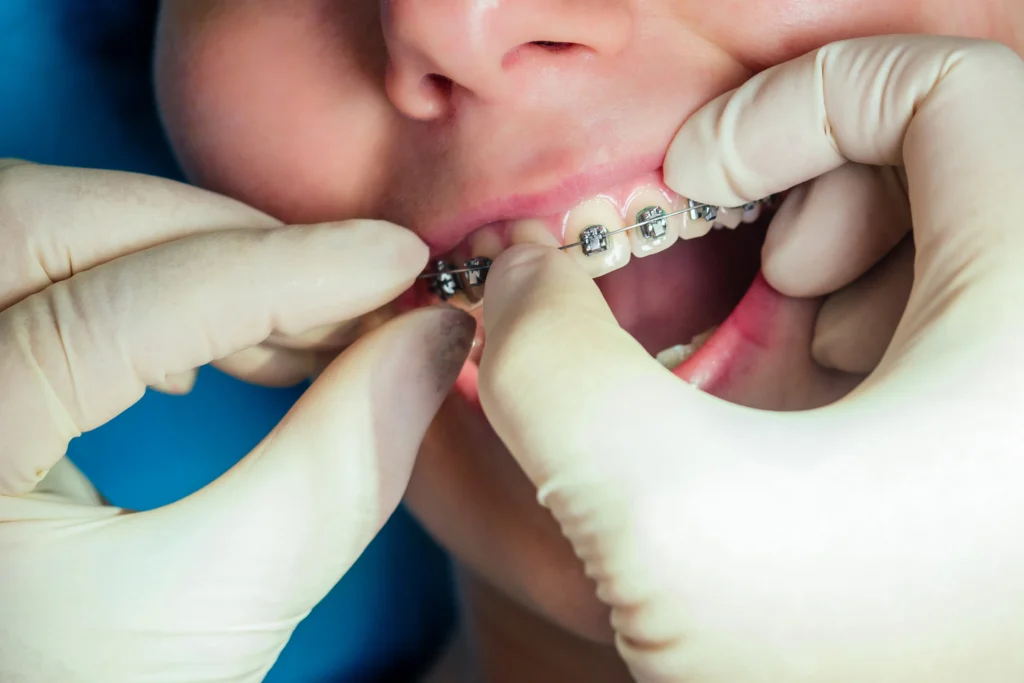 fake braces treatment cozy t