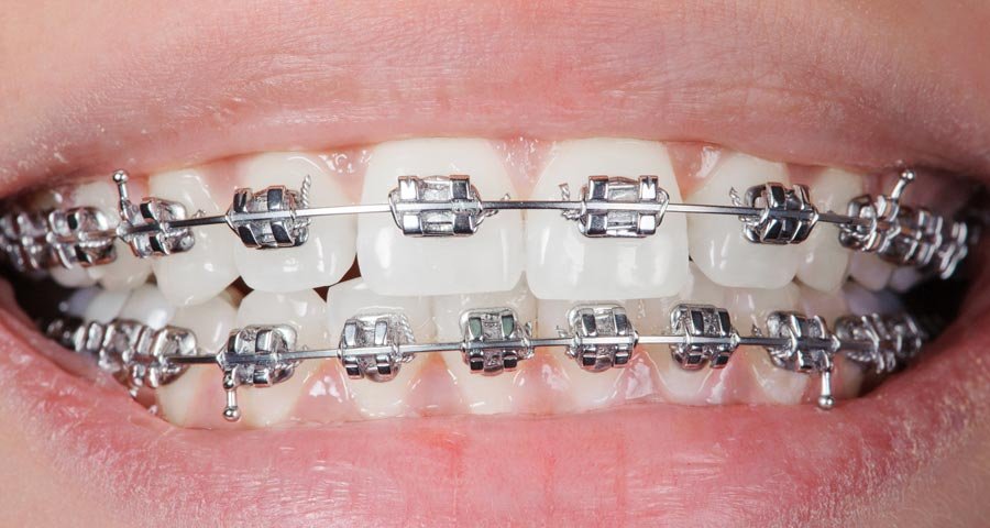 metal braces cozy t 1