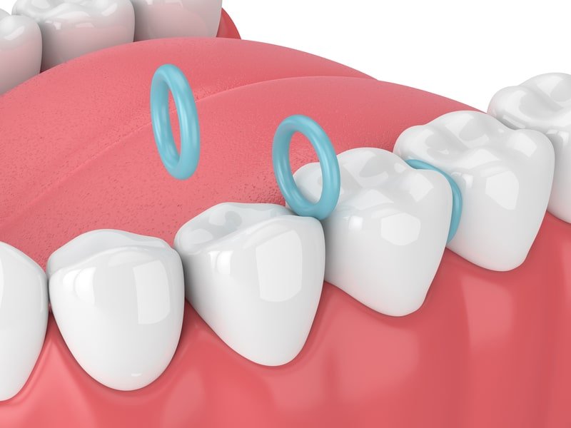 orthodontic-teeth-spacers-for-braces-3D-rendering