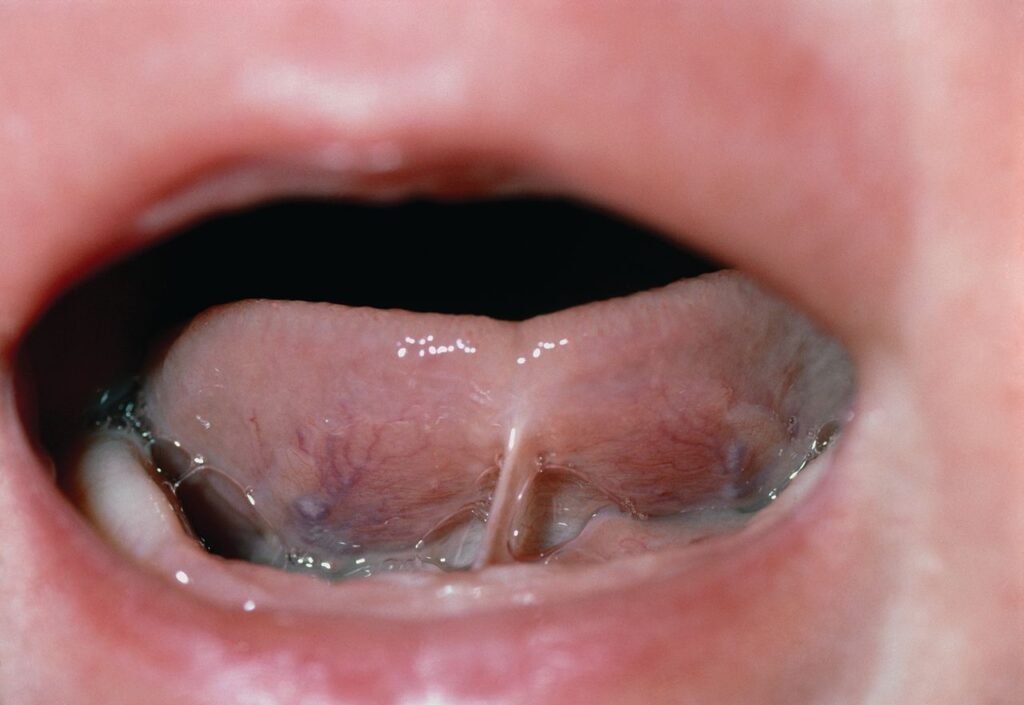 Tongue Tie in Infants: Causes, Symptoms, and Treatment Options in Malaysia 2 causes of tongue tie cozy t senawang