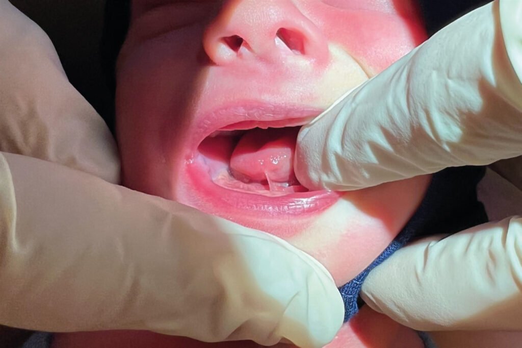Tongue Tie in Infants: Causes, Symptoms, and Treatment Options in Malaysia 5 frenotomy procedure details cozy t senawang