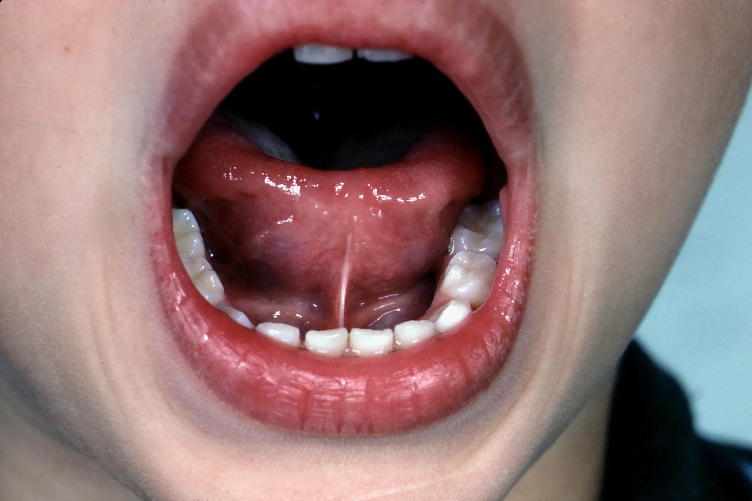 tongue tie classification