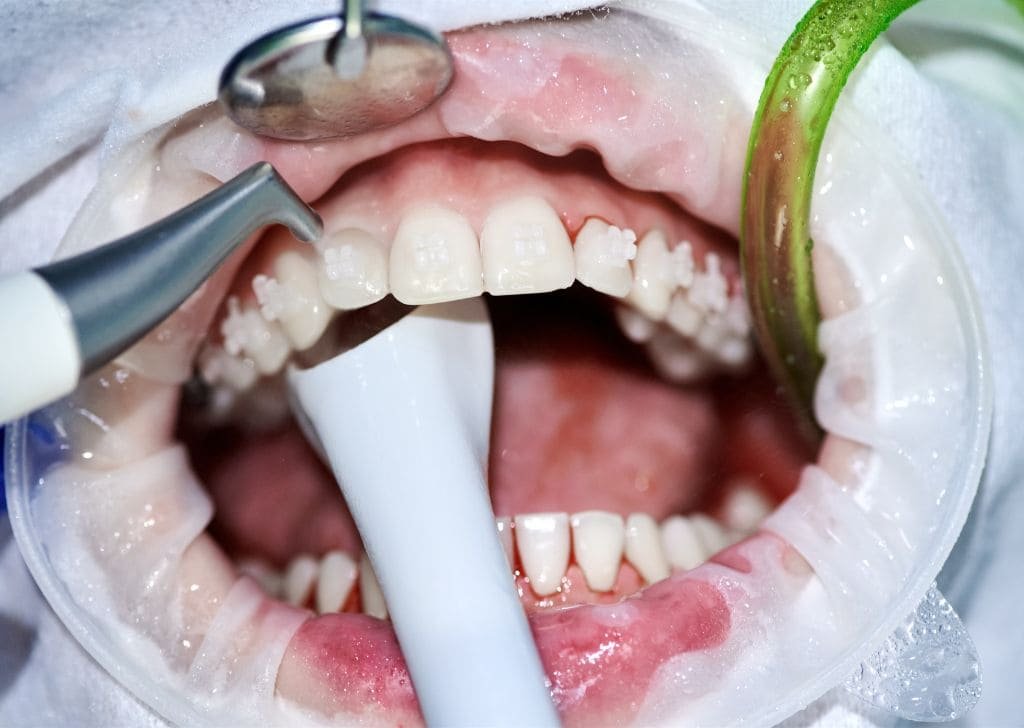 Stress and Teeth Grinding: Understanding Bruxism | Cozy T Dental Seremba