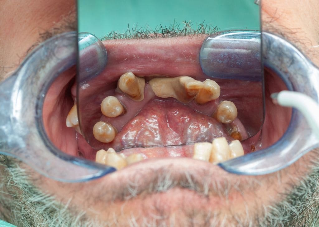 Dental Veneers in Seremban | Natural Smile, Real Results