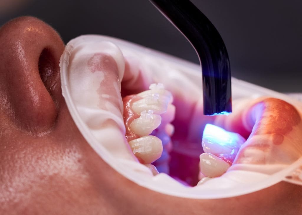 What Is Laser Dentistry Used For? | Cozy T Dental Seremban
