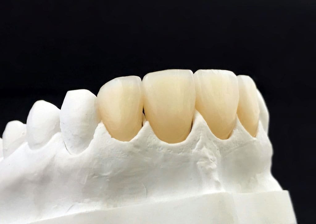 Dental Veneers in Seremban | Natural Smile, Real Results