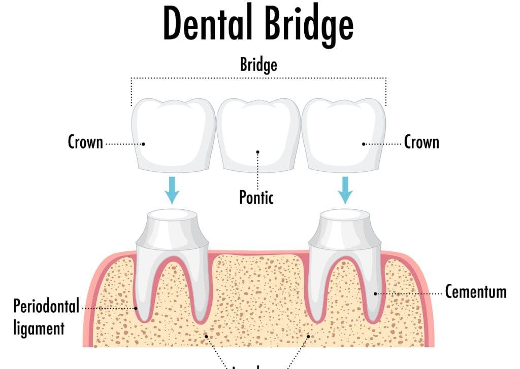 Dental Bridge vs Implant: What’s Best for Your Smile?