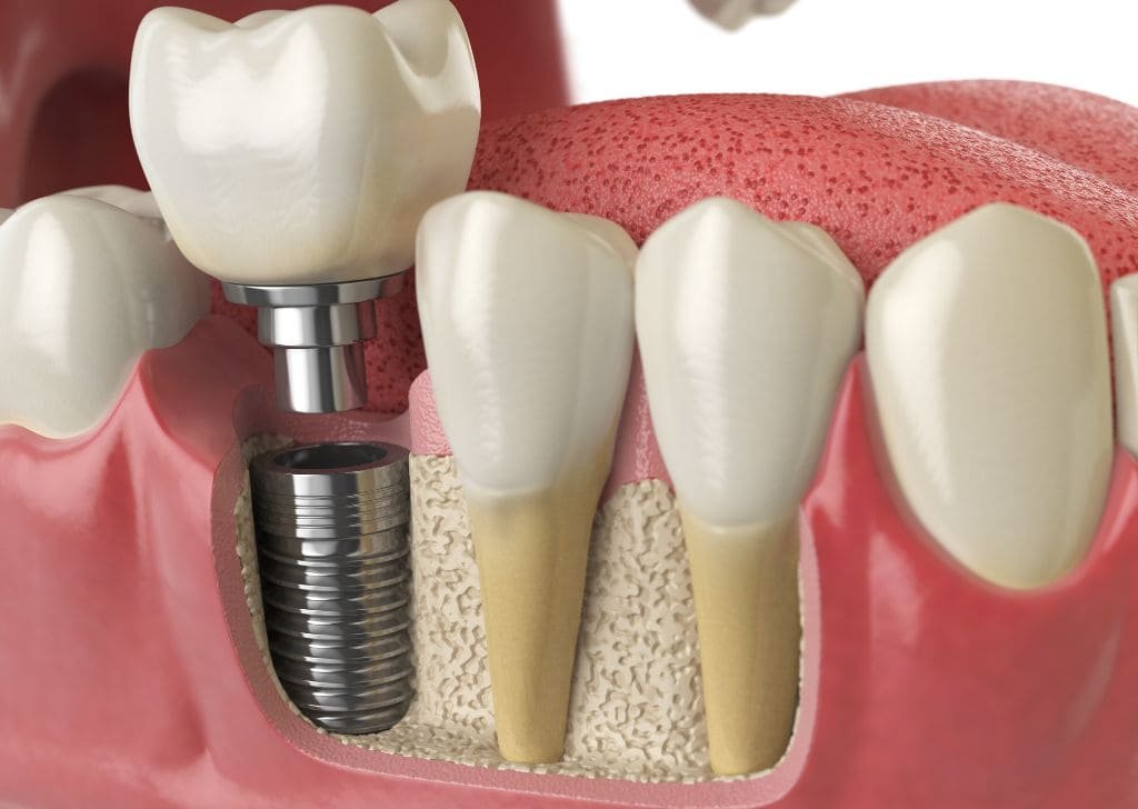 Dental Implant Care Tips for Faster Recovery