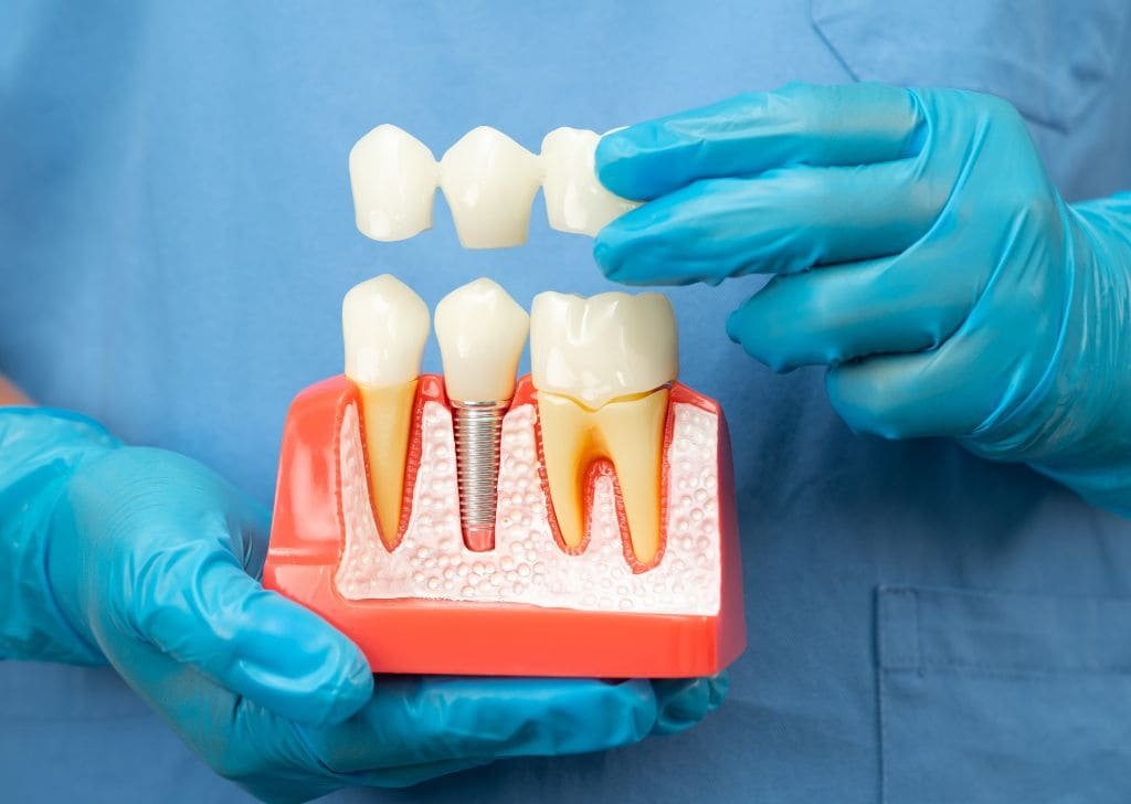 Dental Bridge vs Implant: What’s Best for Your Smile?