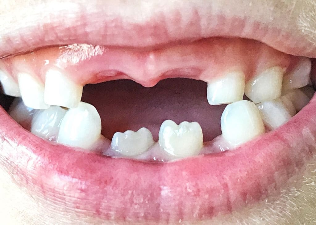 Dental Bridge vs Implant: What’s Best for Your Smile?