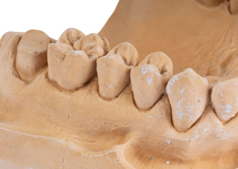 How Bone Health Affects Dental Implants