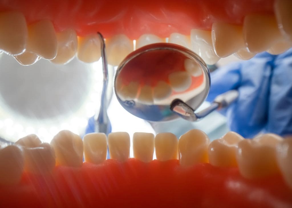 A dentist inspecting a black spot on tooth that may or may not be cavity.