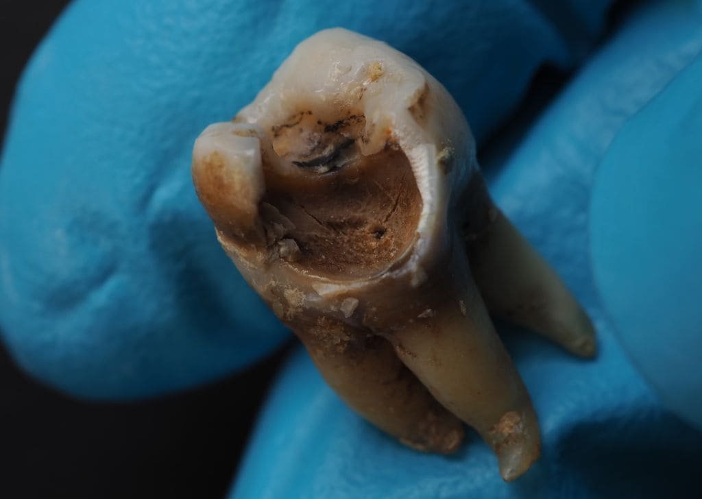 Dentist showing a huge black spot on tooth. It's just cavity. 