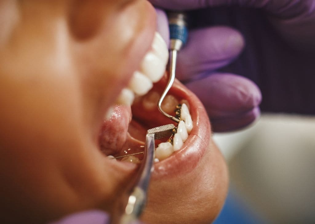 Get that black spot on tooth checked by a dentist to be sure it isn't a cavity. 