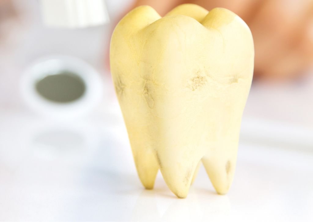 A yellow teeth model used by dentists to explain the process to patients.