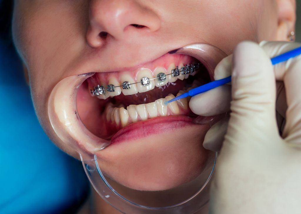 A dentist installing braces on a patient's lower teeth.