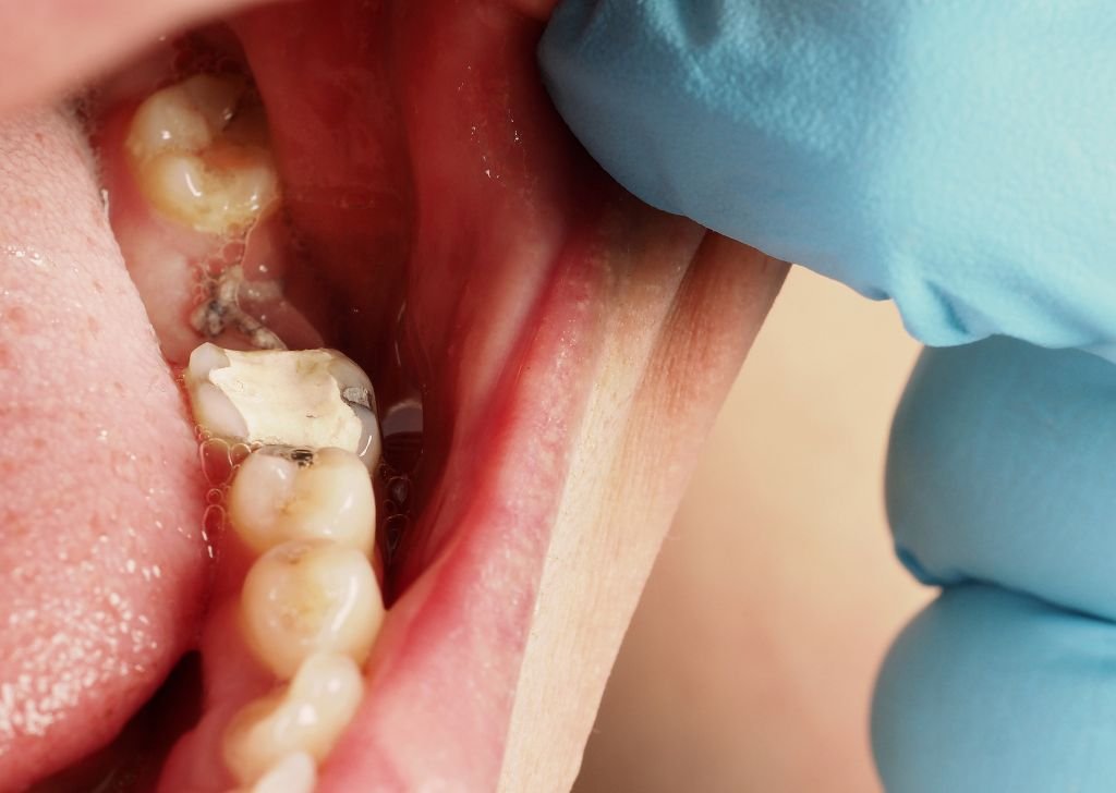 A patient's teeth showing a dental filling and stitches on the gum.
