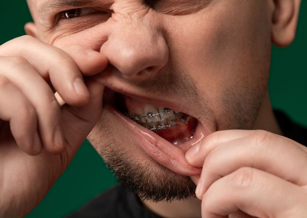 A man playing with his lips, possibly due to pain from side effects from getting braces.