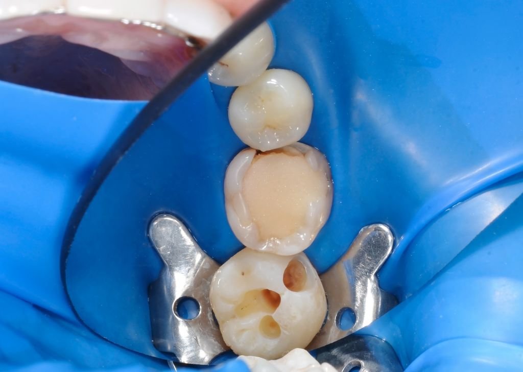 A dentist showing a dental filling and the holes drilled on a teeth to allow another filling.