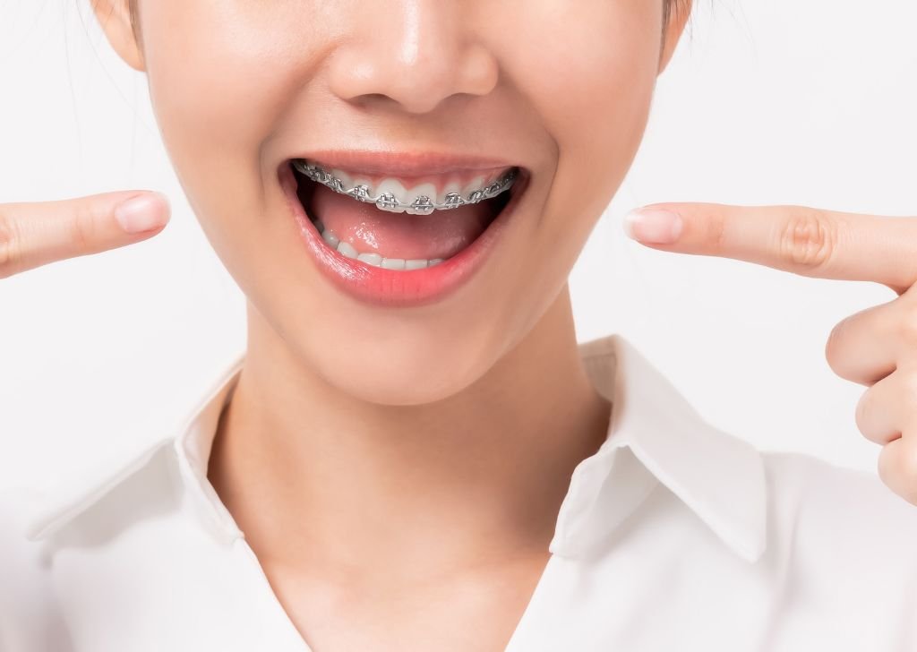 A healthy woman pointing at her perfect teeth with no side effects after getting braces.
