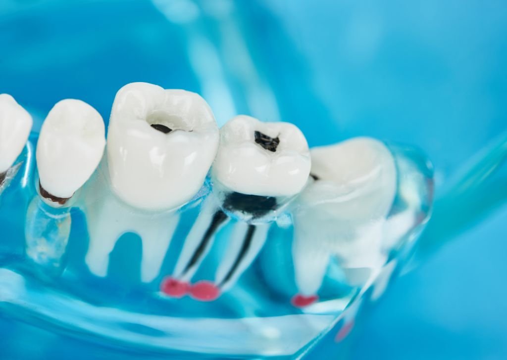 A dental model used to show where the caries are and where a dental filling is required.