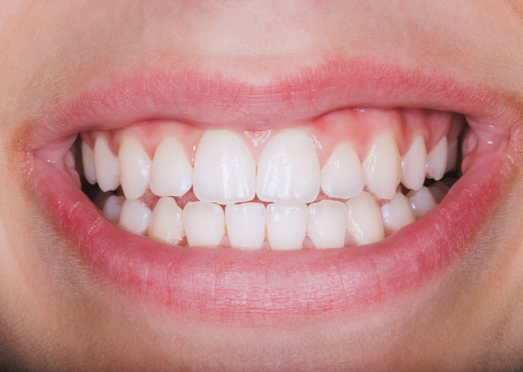 Close-up of a smile showing healthy pink gums and white teeth.