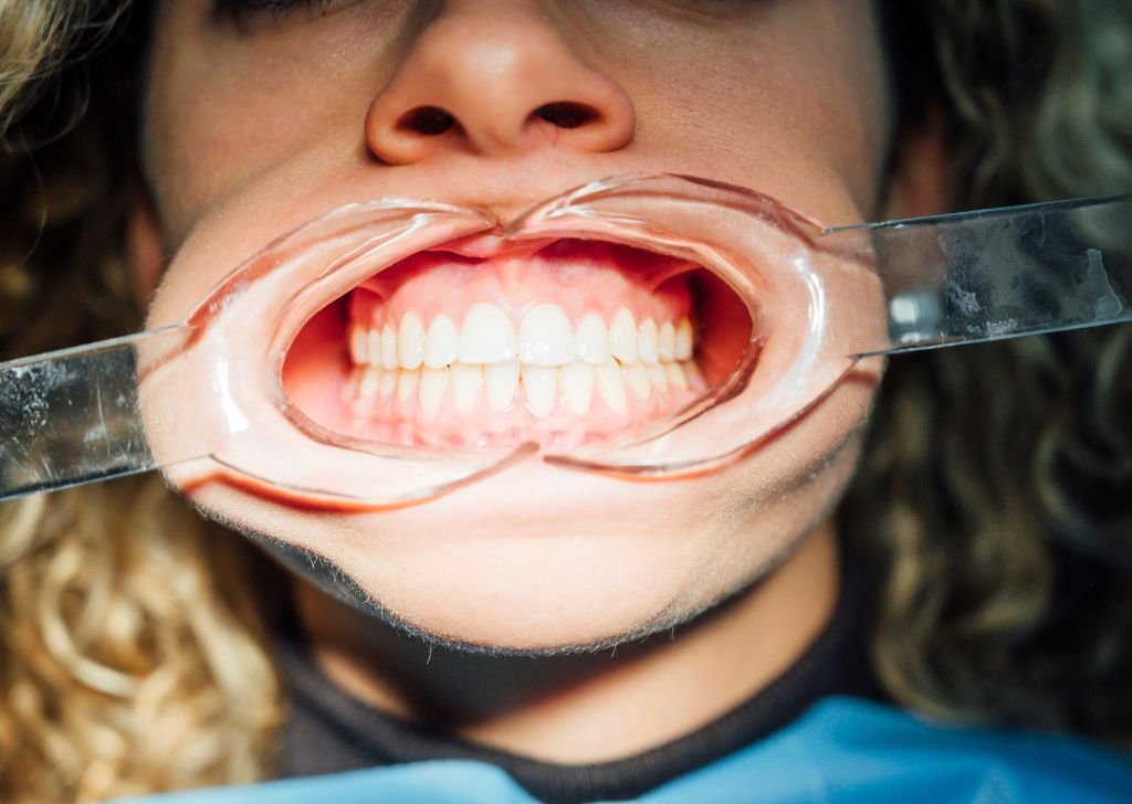Close-up mouth with dental retractor exposing gums and teeth for inspection.