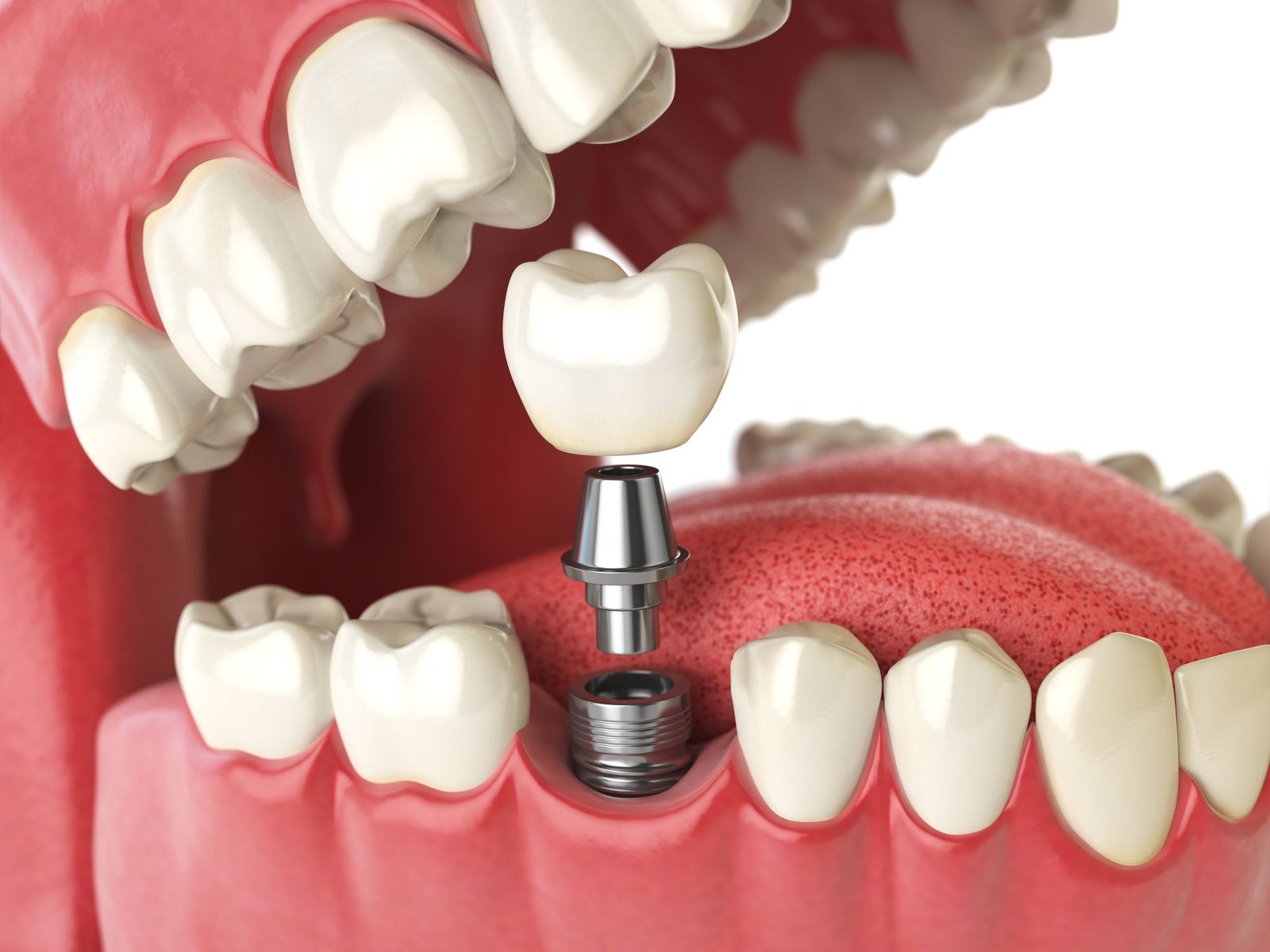 Dental Implants3