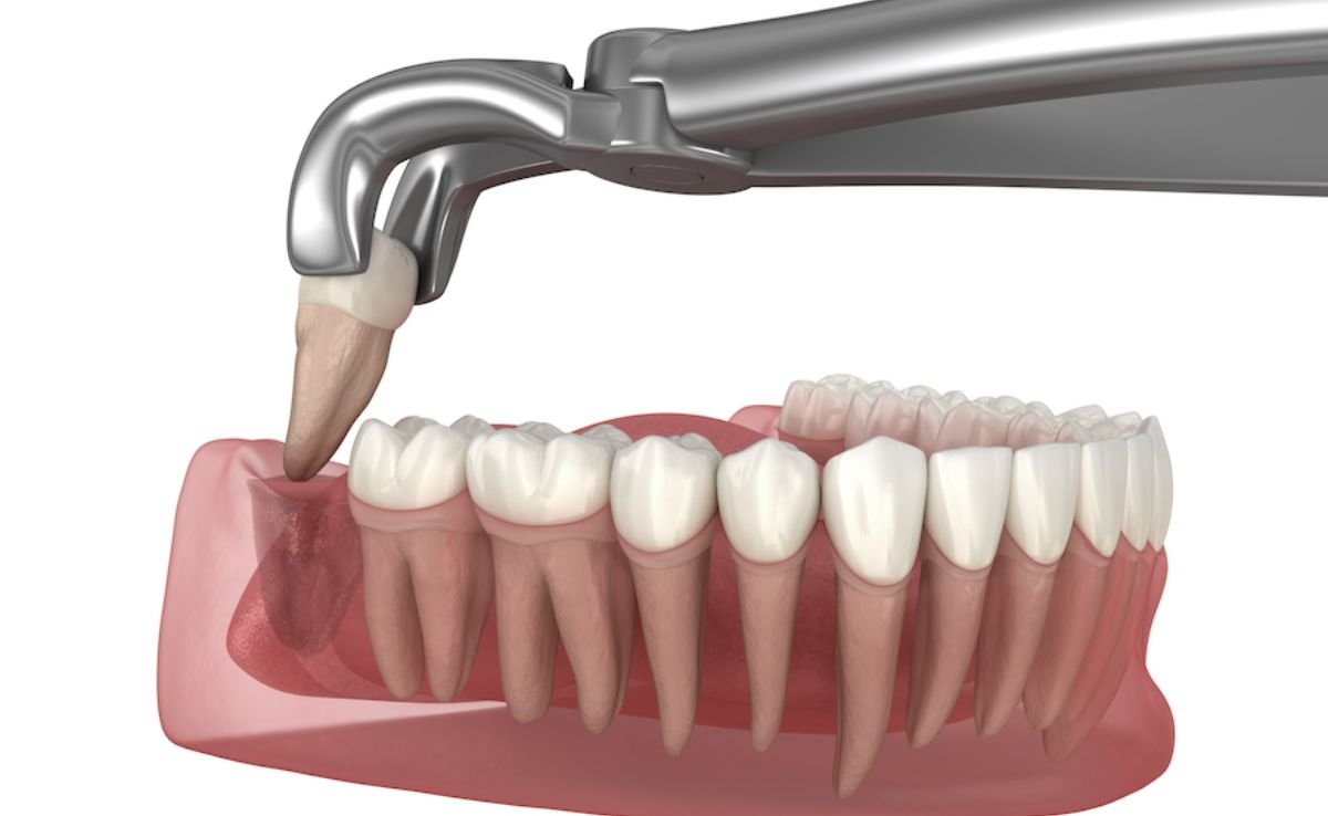 Wisdom Teeth Surgery in Senawang, Seremban 9 Simple wisodm tooth extraction