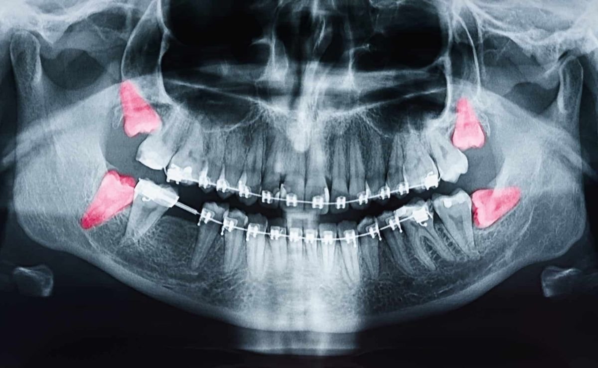 Oral and Maxillofacial Surgery in Seremban 15 Impacted Wisdom Teeth