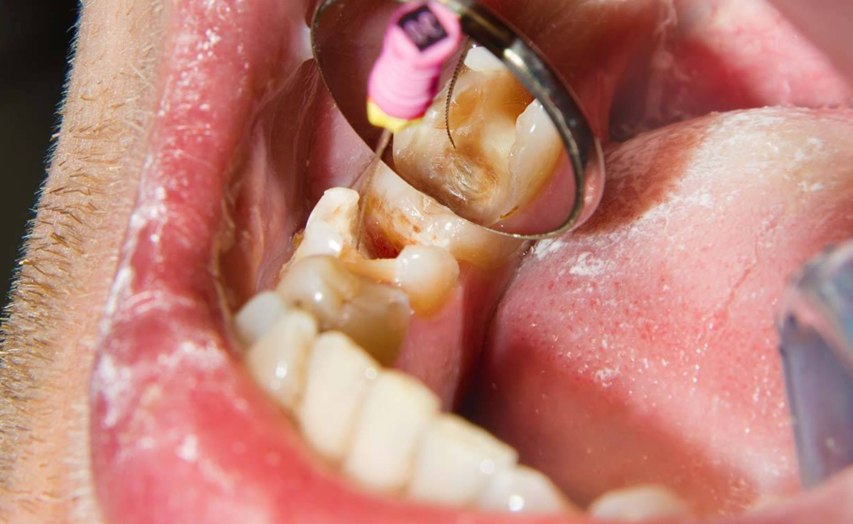 Root Canal Treatment in Senawang, Seremban 30 Pulp removal