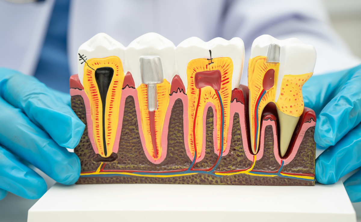 Root Canal Treatment in Senawang, Seremban 32 Filling the canal