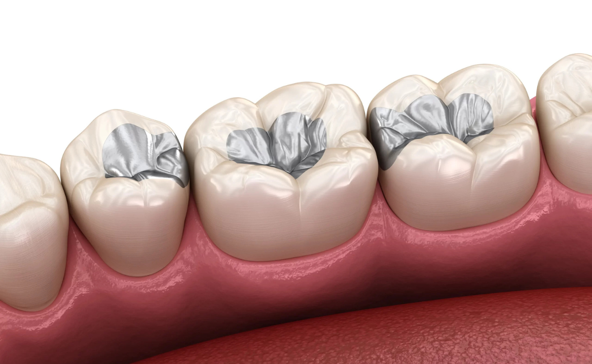 Root Canal Treatment in Senawang, Seremban 33 Temporary Filling
