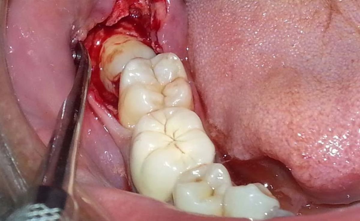 Wisdom Teeth Surgery in Senawang, Seremban 10 2 1