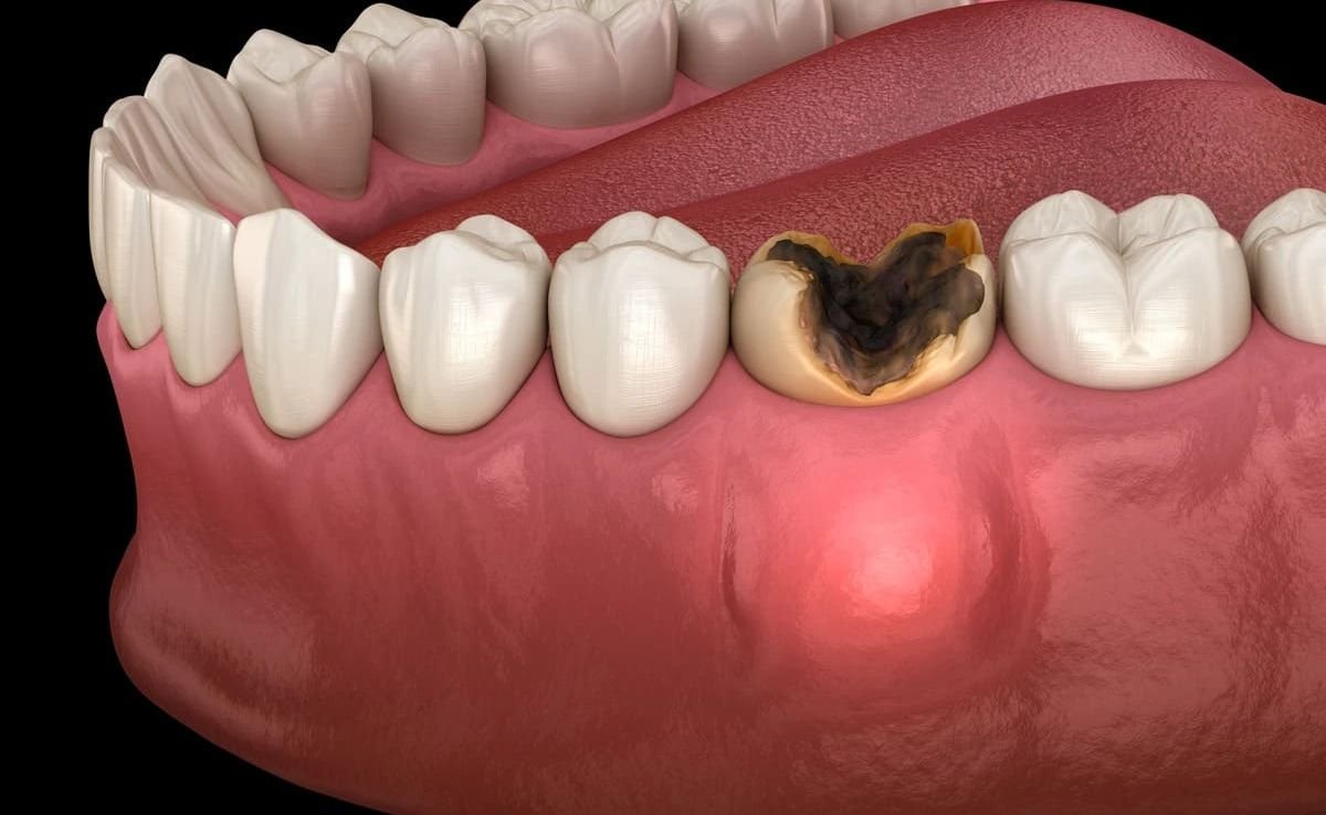 Oral and Maxillofacial Surgery in Seremban 16 Severe Tooth Infection