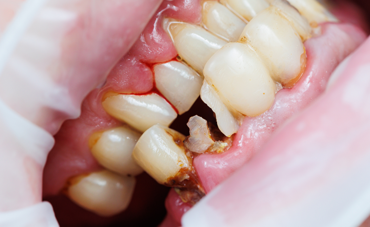 Root Canal Treatment in Senawang, Seremban 21 Broken teeh