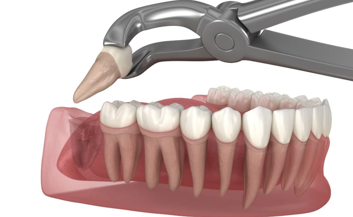 Wisdom Teeth Surgery in Senawang, Seremban 13 5 1