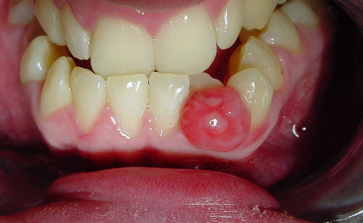 Oral and Maxillofacial Surgery in Seremban 20 Oral Growths