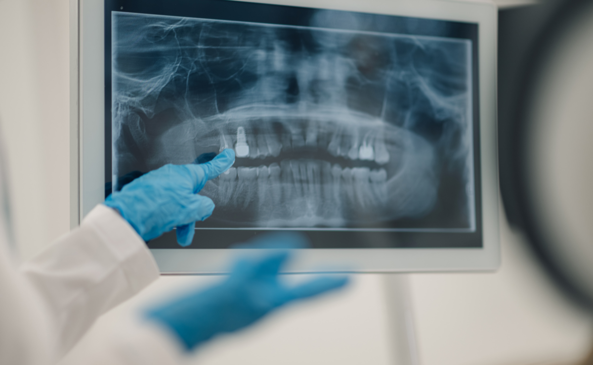 Root Canal Treatment in Senawang, Seremban 27 Dental X ray