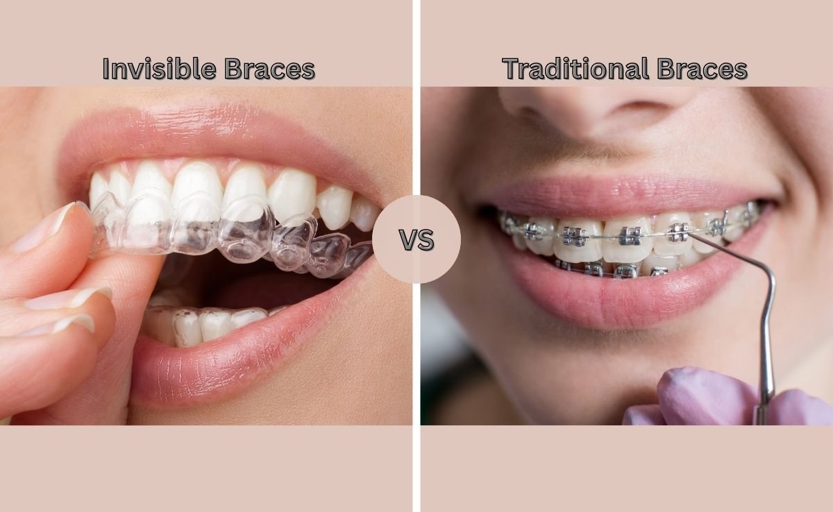 Invisible Braces vs Traditional Braces
