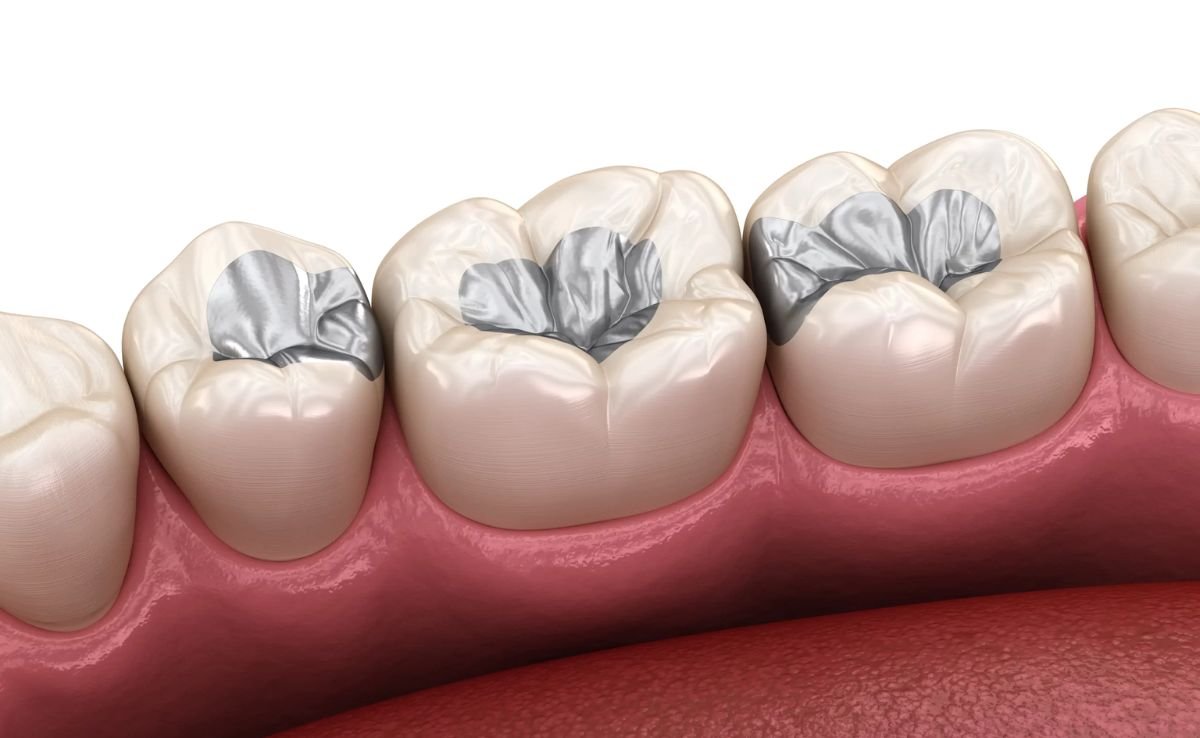 Tooth Filling in Malaysia: When You Need It, Costs & What to Expect